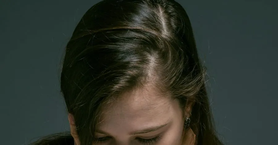 Female-Pattern Baldness: Causes, Symptoms, and Treatments for Women